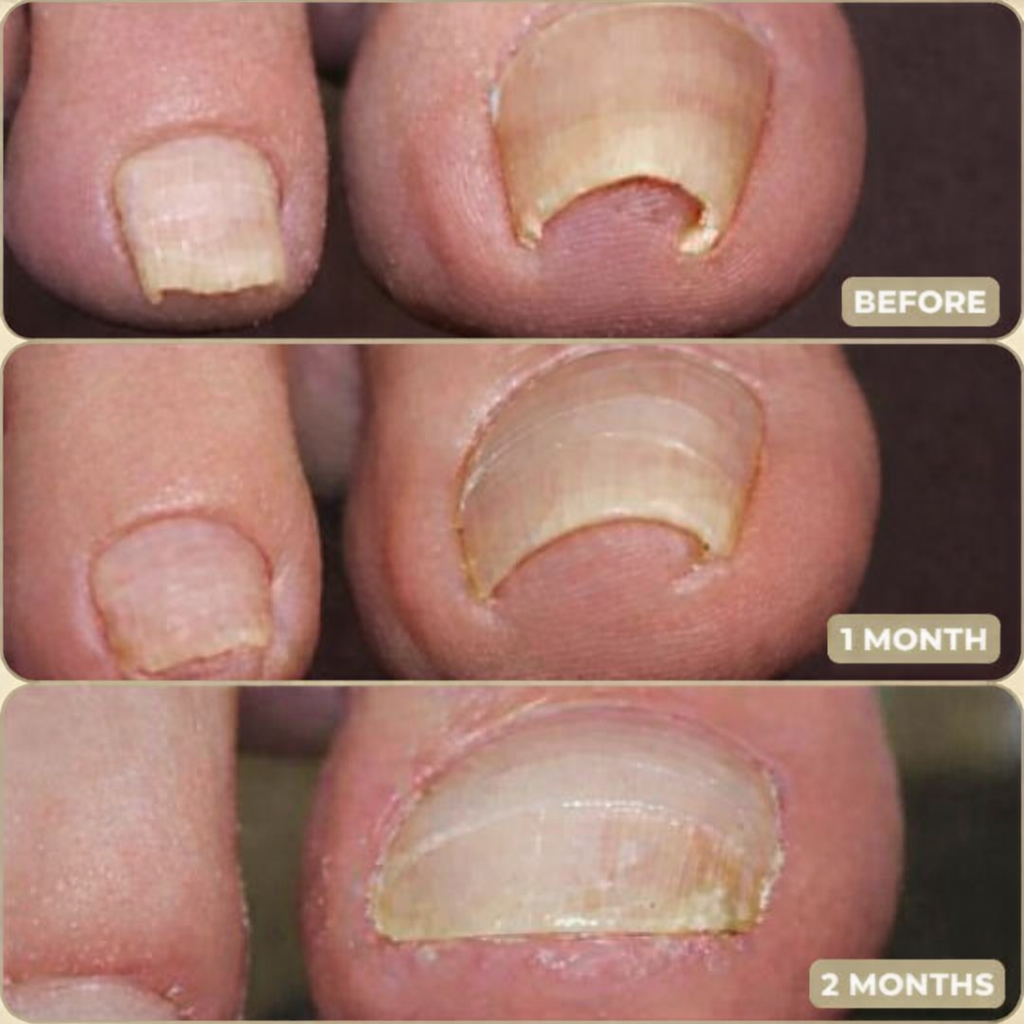 Nail Care Patches – Effective Relief for Ingrown Toenails